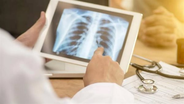 الصحة تكشف عن أجهزة تشخيصية جديدة تسهم في سرعة اكتشاف الدرن وتحسين السيطرة على المرض